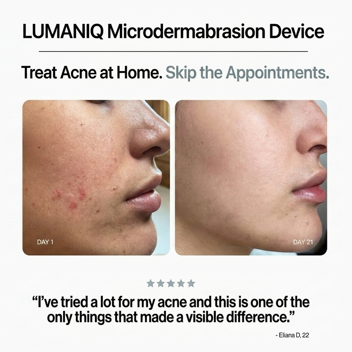 Diamond Microdermabrasion Device