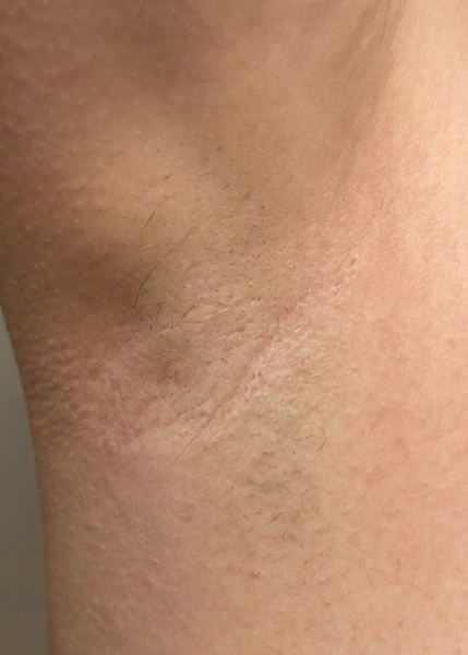 After 85 days, Rachel, 31