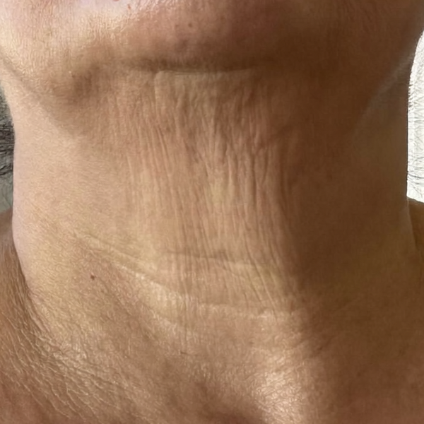 Before – Rachel M, 55