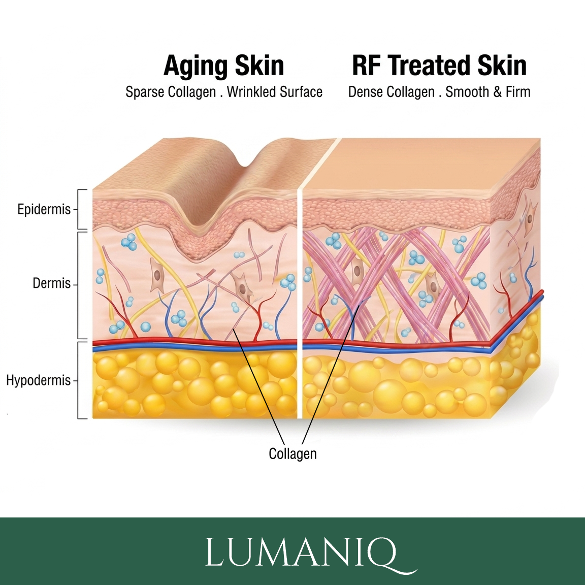 RF Skin Tightening Wand