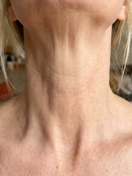 Before – Alana Z, 47
