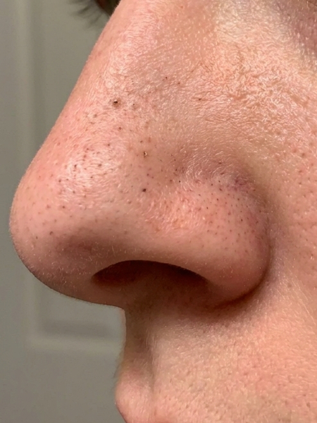 Before – Mariel F, 38