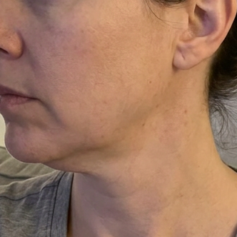 Before – Michelle T, 49