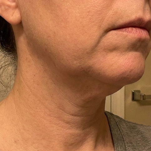 Before – Debra L, 54
